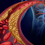زنگ خطر‌هایی که نشان دهنده کلسترول بالاست