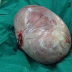 خروج توده ۱۱ کیلویی از شکم بیمار آملی + جزییتن