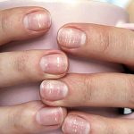 نقاط سفید روی ناخن نشانه چیست؟