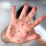 حذف سرخک و سرخجه در ایران توسط سازمان جهانی بهداشت تایید شد