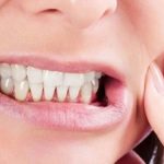 پوسیدگی دندان باعث ابتلا به این بیماری‌ها می‌شود