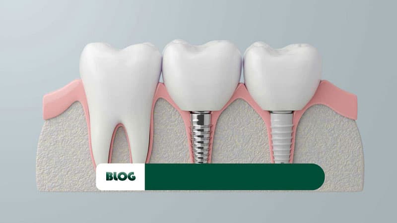 ایمپلنت دندان