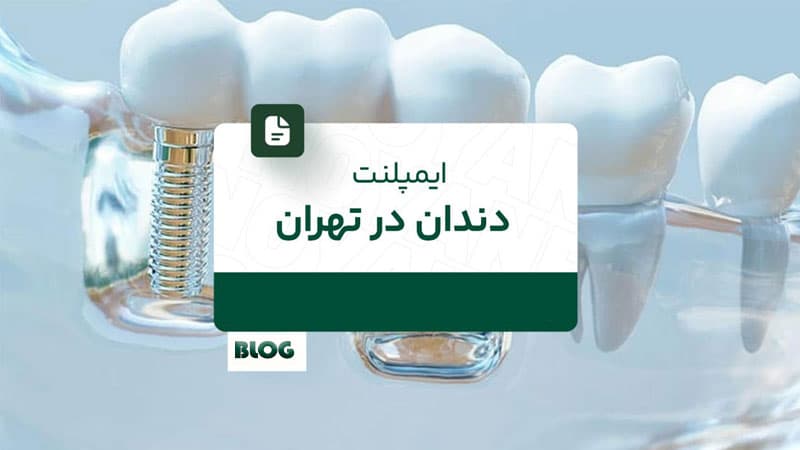 بهترین دندانپزشکی ایمپلنت دندان در تهران