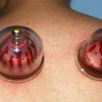 خواص حجامت برای جوش صورت + تاثیر حجامت کردن برای درمان جوش صورت خواص حجامت برای جوش صورت + تاثیر حجامت کردن برای درمان جوش صورت