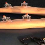 خواص حجامت ساقین + از بین بردن درد پا با حجامت ساقین خواص حجامت ساقین + از بین بردن درد پا با حجامت ساقین