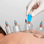 عوارض حجامت + همه چیز درباره عوارض حجامت کردن عوارض حجامت + همه چیز درباره عوارض حجامت کردن