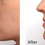 تأثیر ارتودنسی بر فرم صورت | بررسی تخصصی